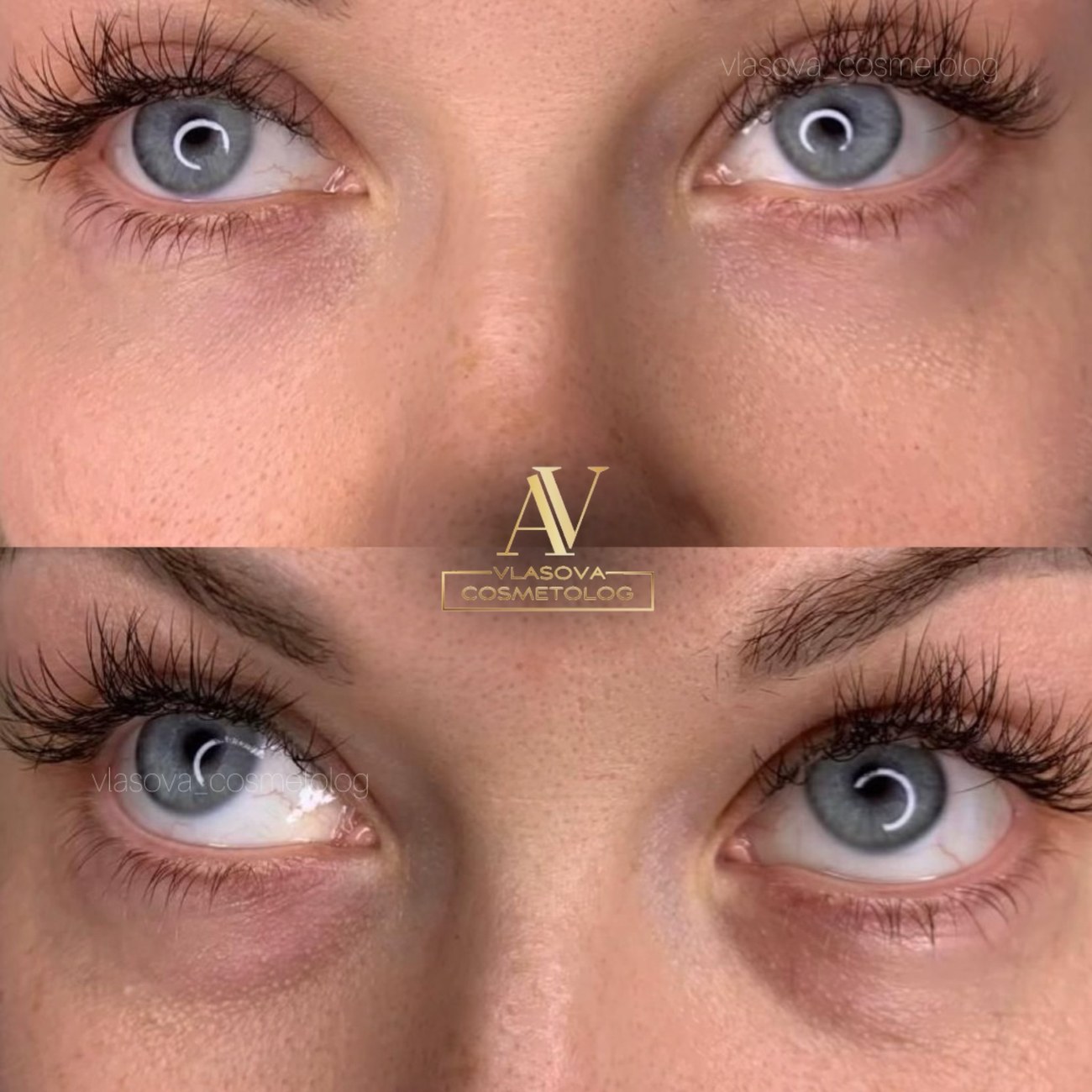 Under-eye rejuvenation before and after