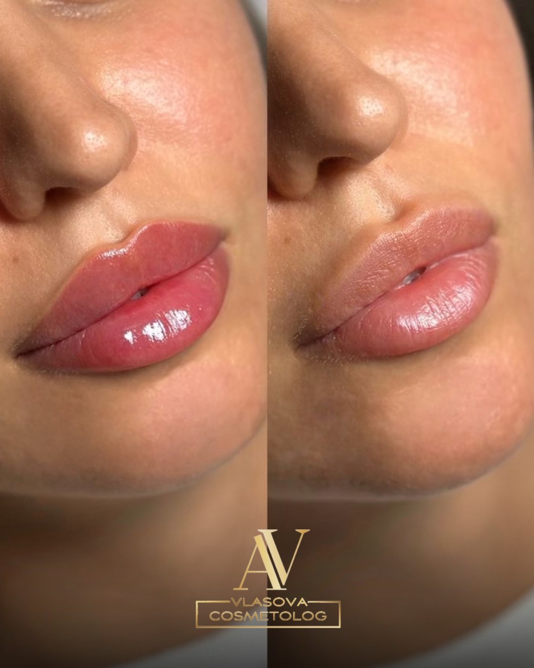 Lip filler before and after