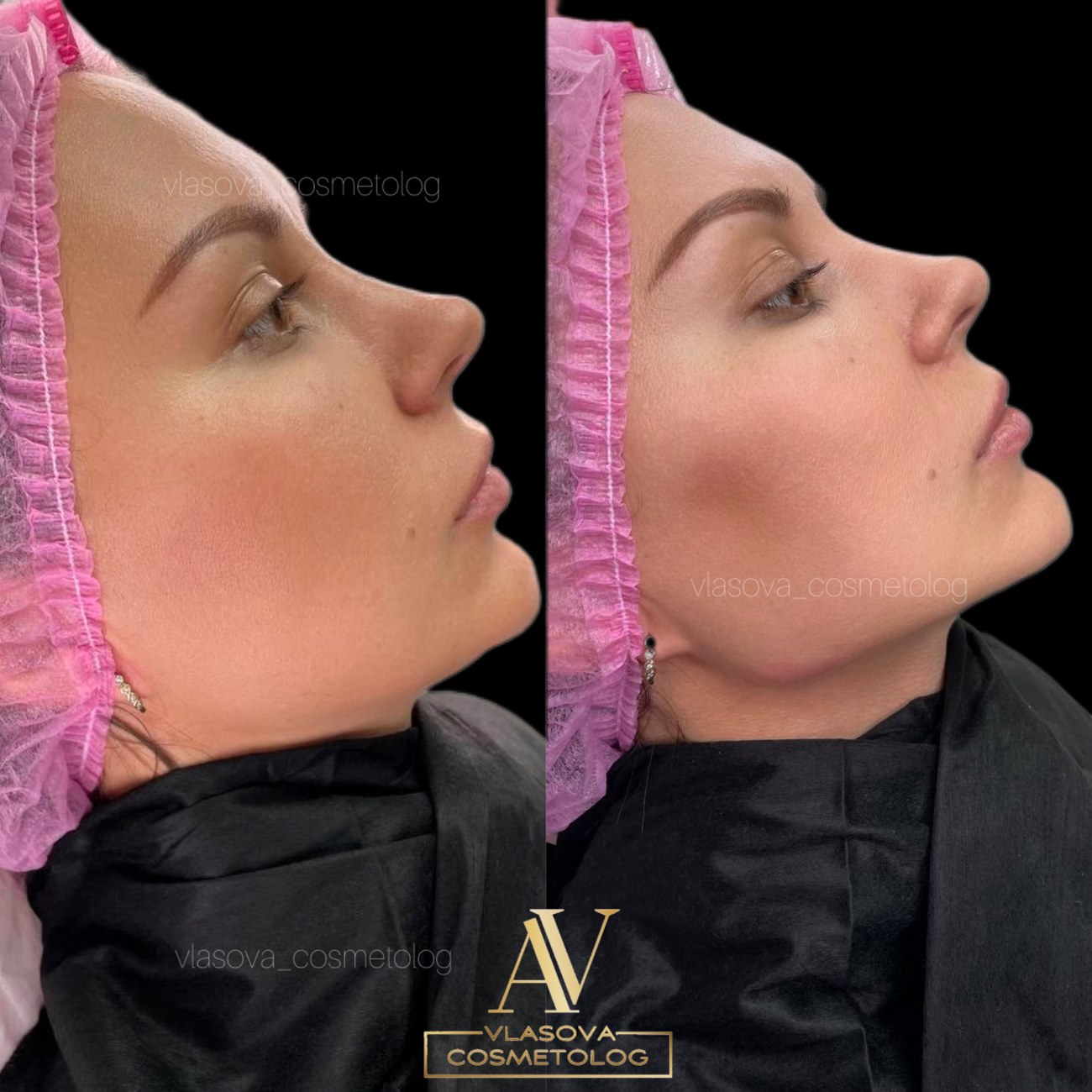 Profile balancing before and after