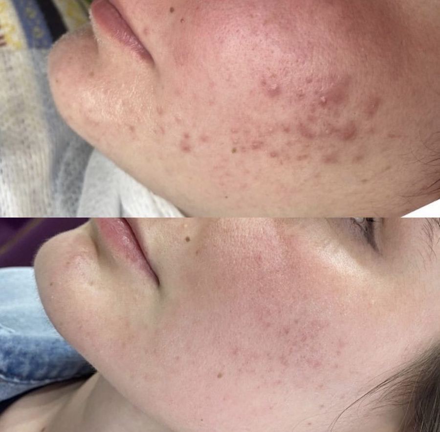 Acne Treatment — before and after