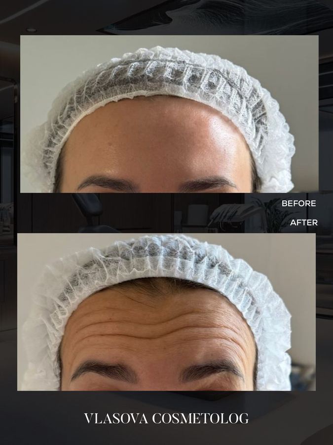 Baby Botox — before and after