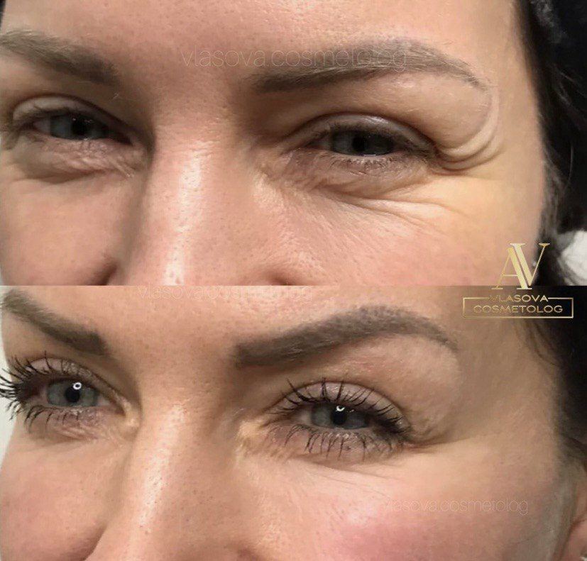 Botox — 1 Area — before and after