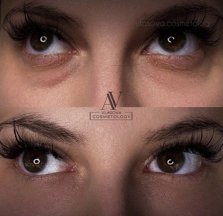 Under Eye Threads — before and after