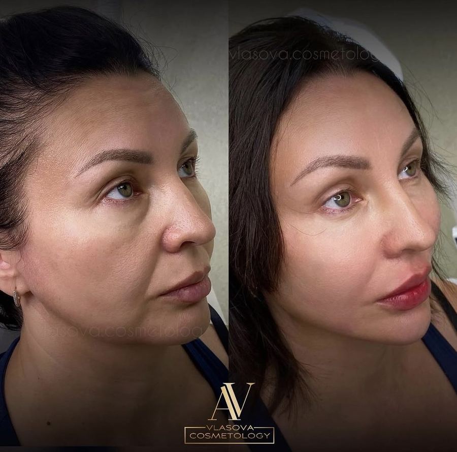 Facetem — before and after