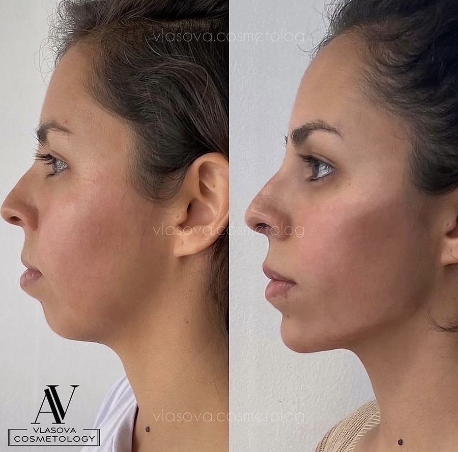 1 Area — cheeks, chin, jaw or nasolabial — before and after