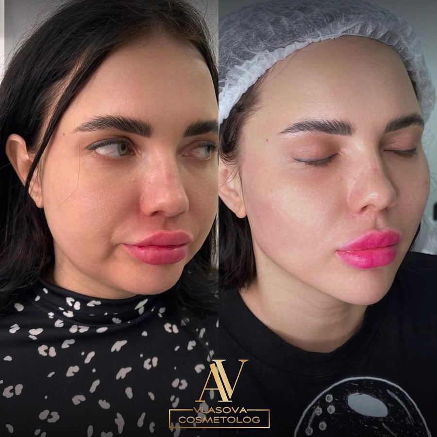 Full Face — 5 ml — before and after