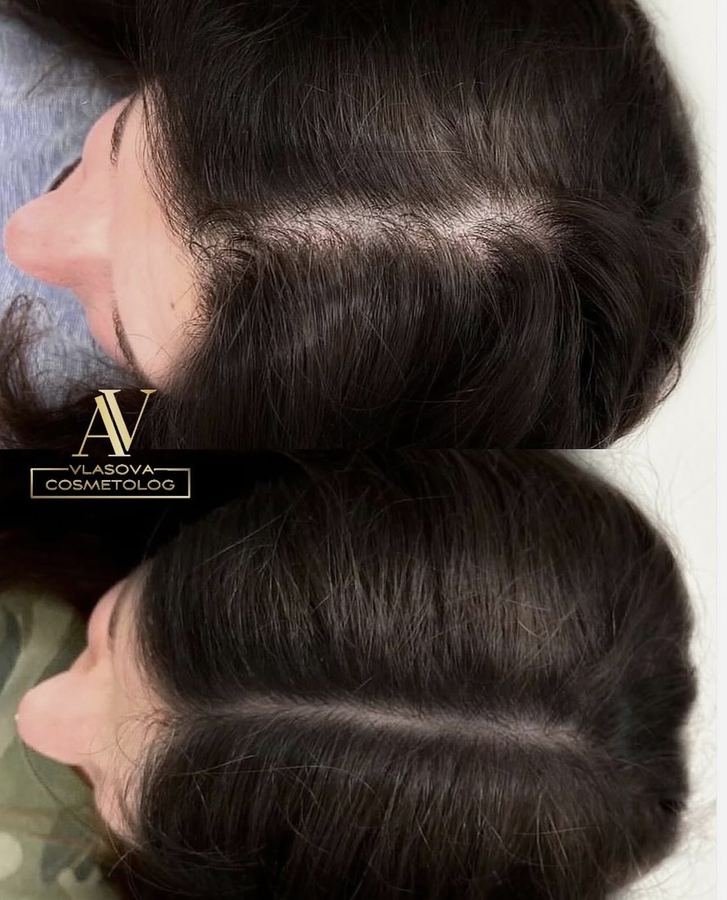 Exosome Hair Restoration — before and after