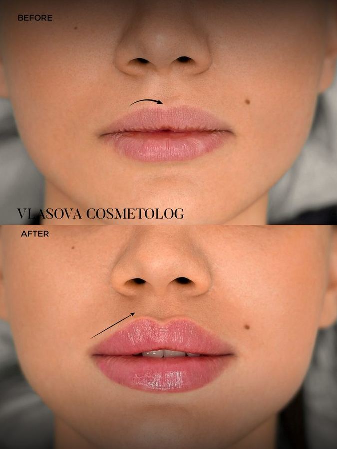 Hydrating Lip Filler — before and after