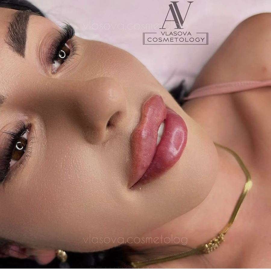 Lip Filler — Stylage 1 ml — before and after