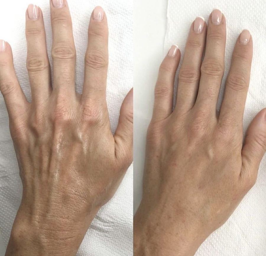 Radiesse — Hands — before and after