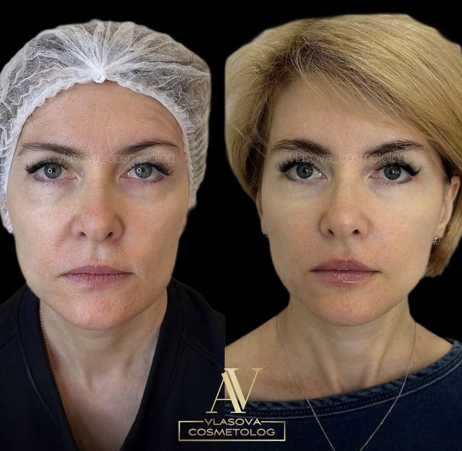 Radiesse — Full Face & Neck — before and after
