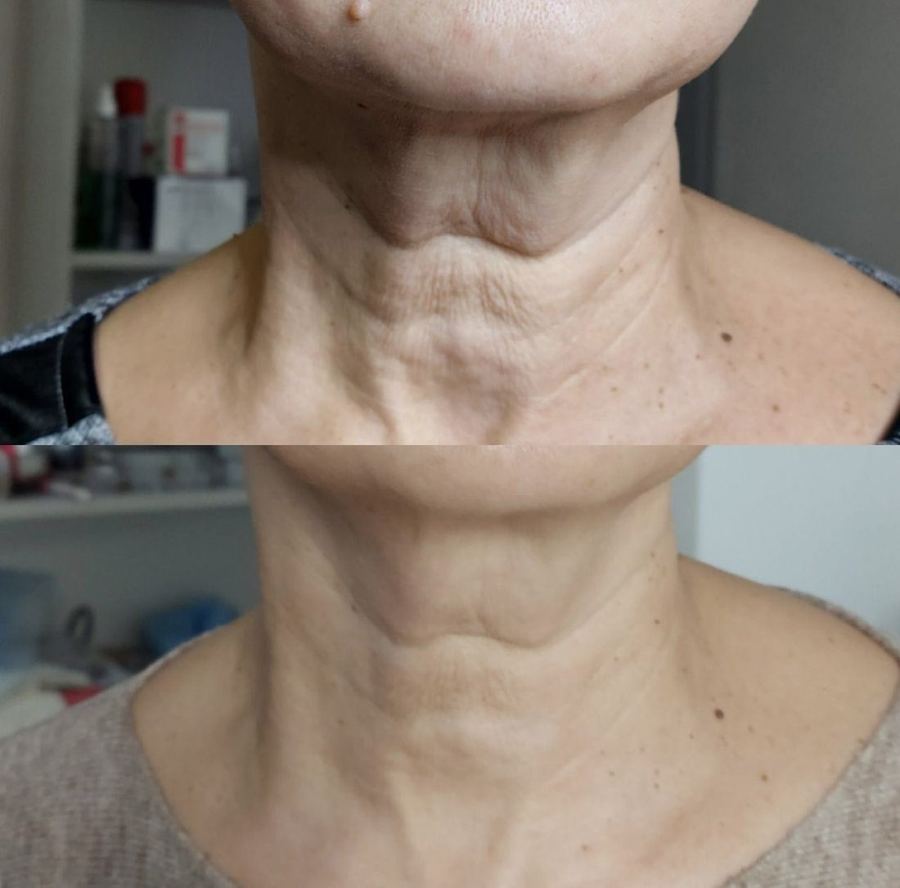 Radiesse — Full Face & Neck — before and after
