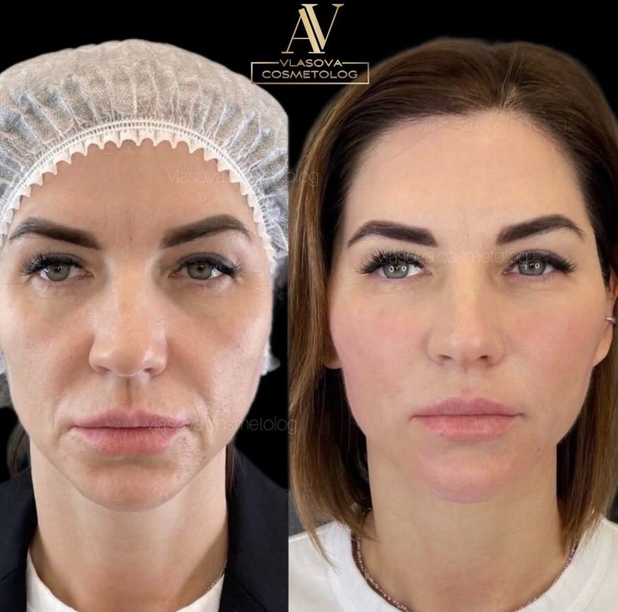 Radiesse — before and after