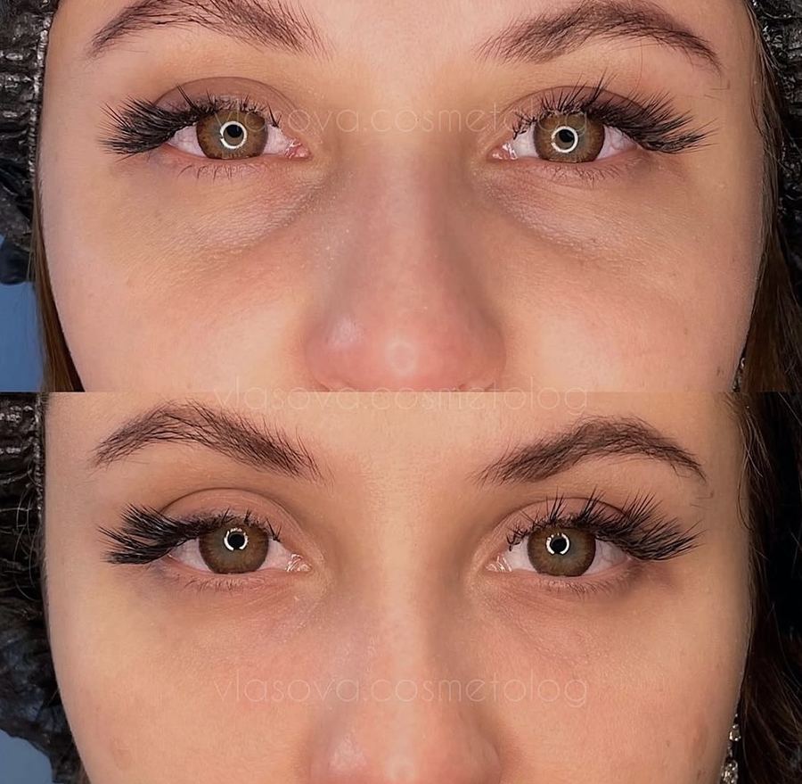 Teosyal Redensity — under eye — before and after